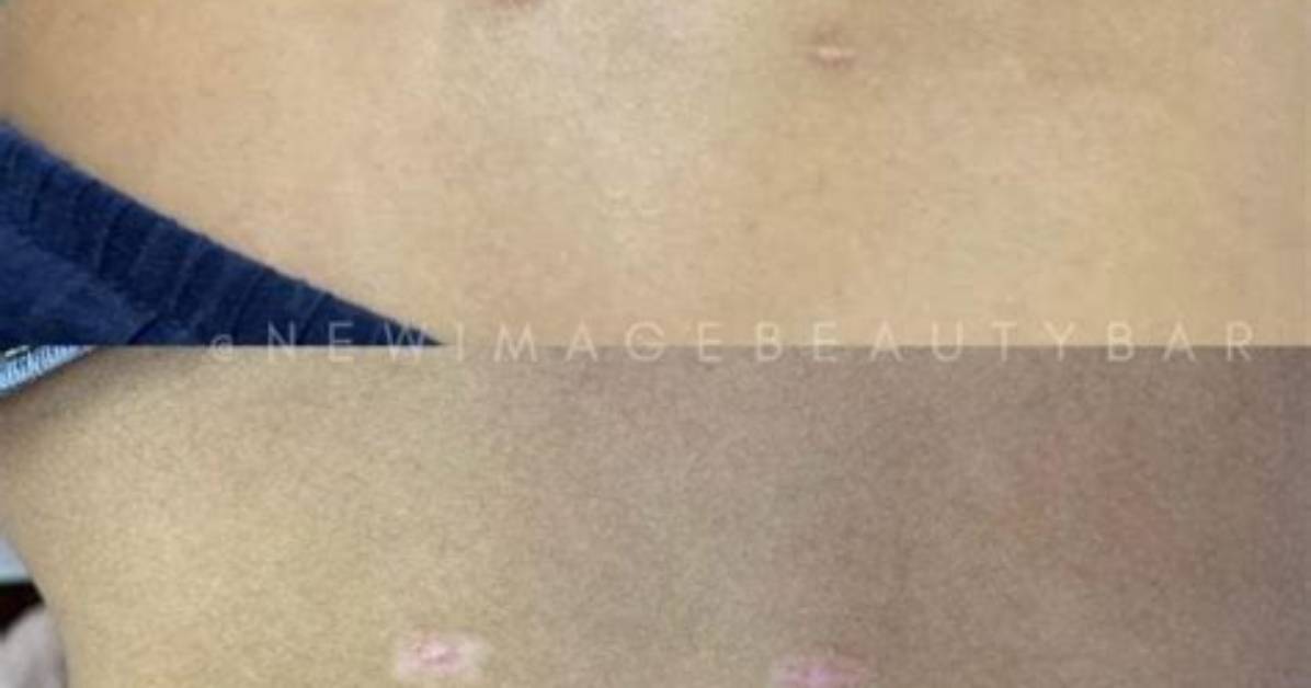 Do You Get Scars from Bbl?