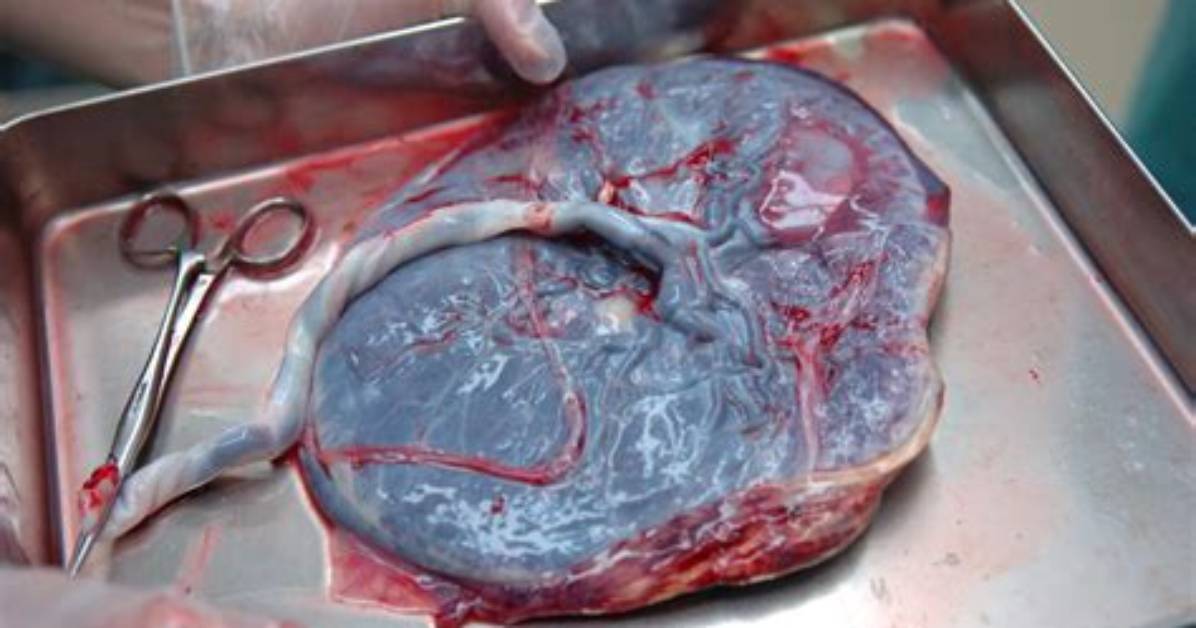 Do You Have to Push the Placenta out?