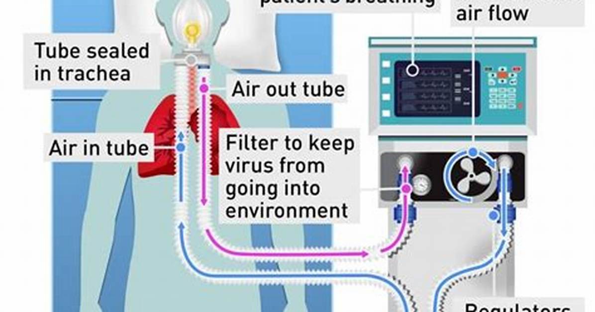 Do You Need a Ventilator with a Tracheostomy