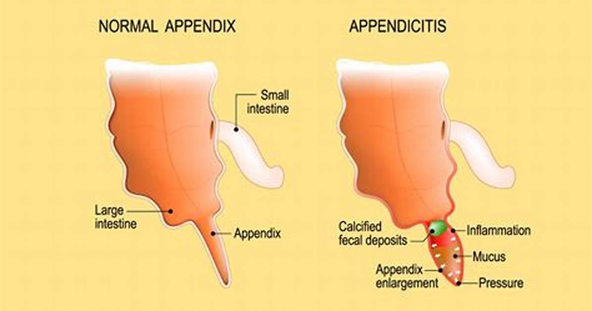Do You Need an Appendix?