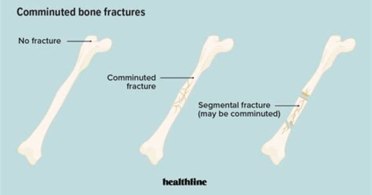 Do You Need Surgery for a Comminuted Fracture?