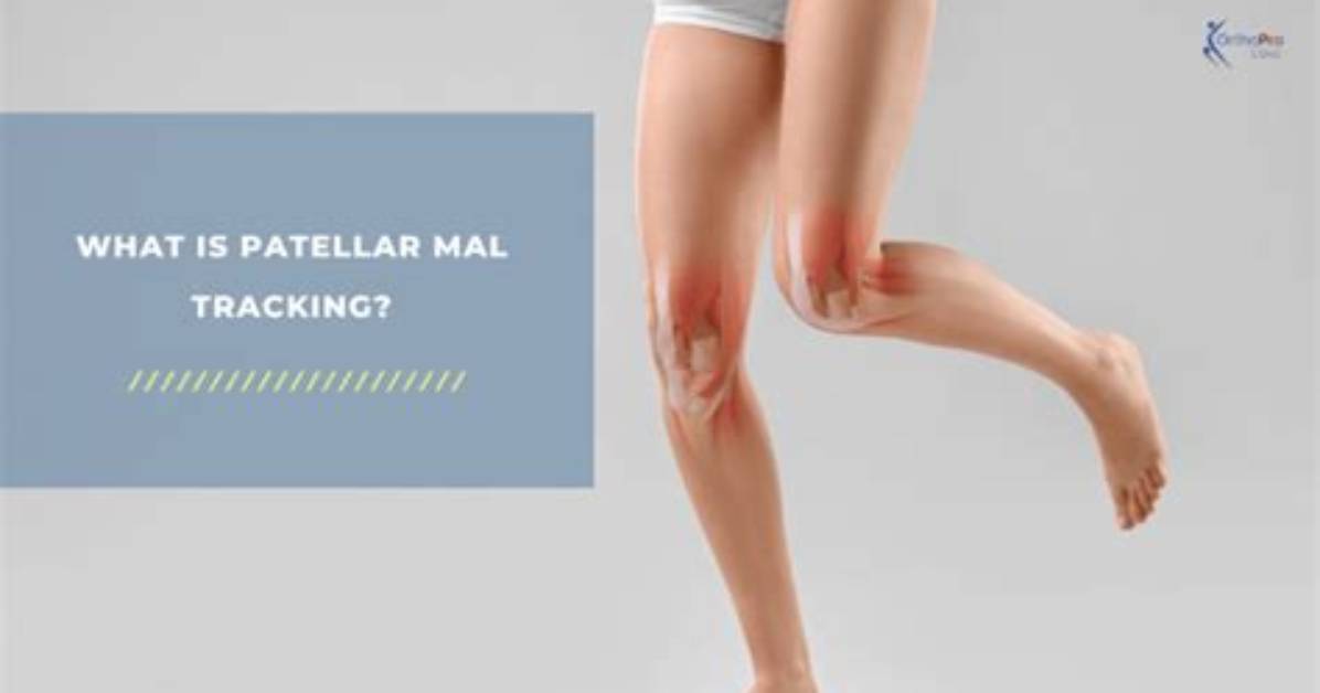 Do You Need Surgery for Patellar Tracking Disorder?