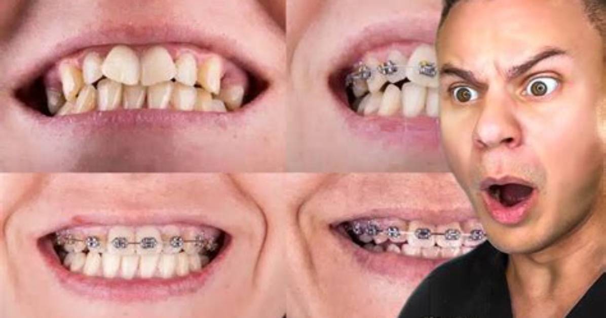 Do You Talk Weird with Braces?