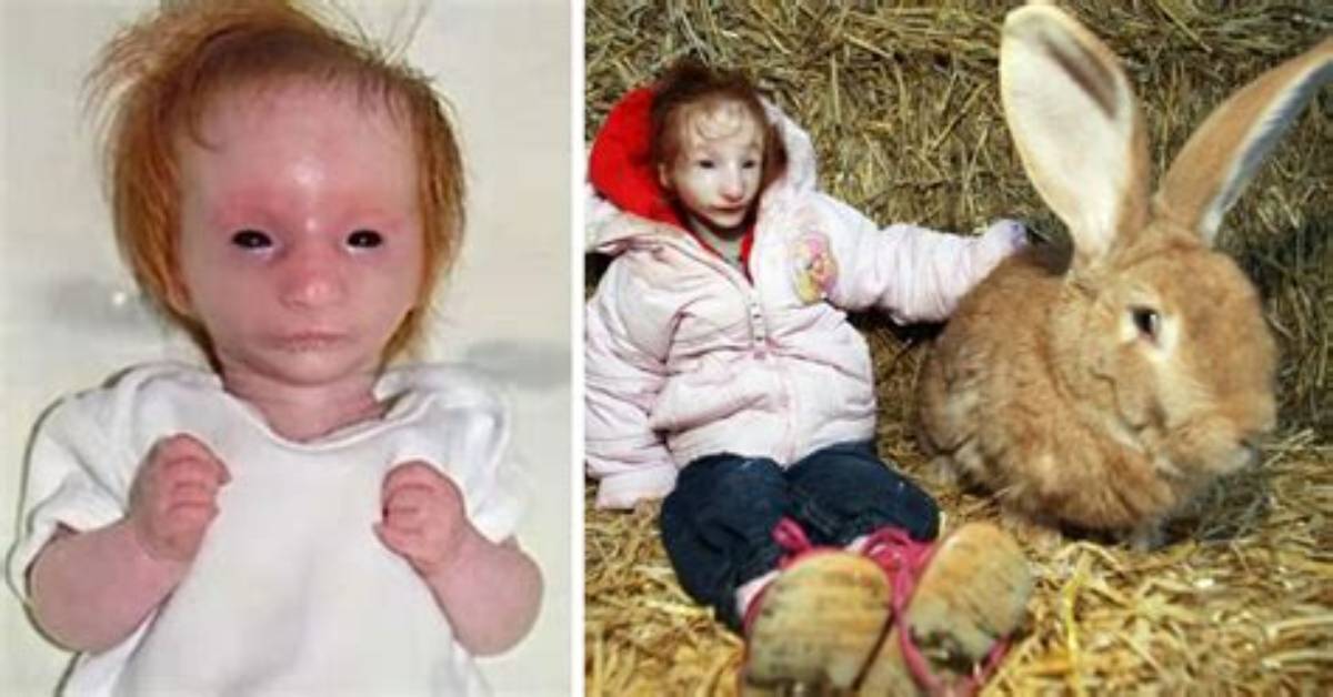 Doctors Gave “World’s Tiniest Girl” a Death Sentence – but She Keeps Proving Them Wrong