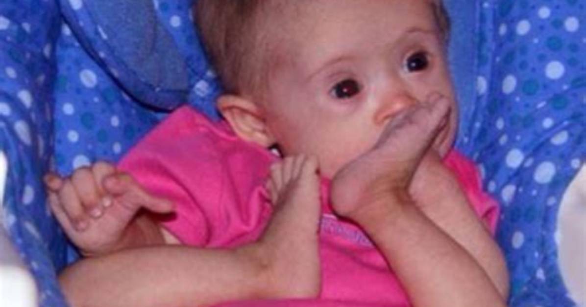 Doctors Wanted to Put Girl with Down Syndrome in an Institution – 15 Year's Later, She’s a Top Model
