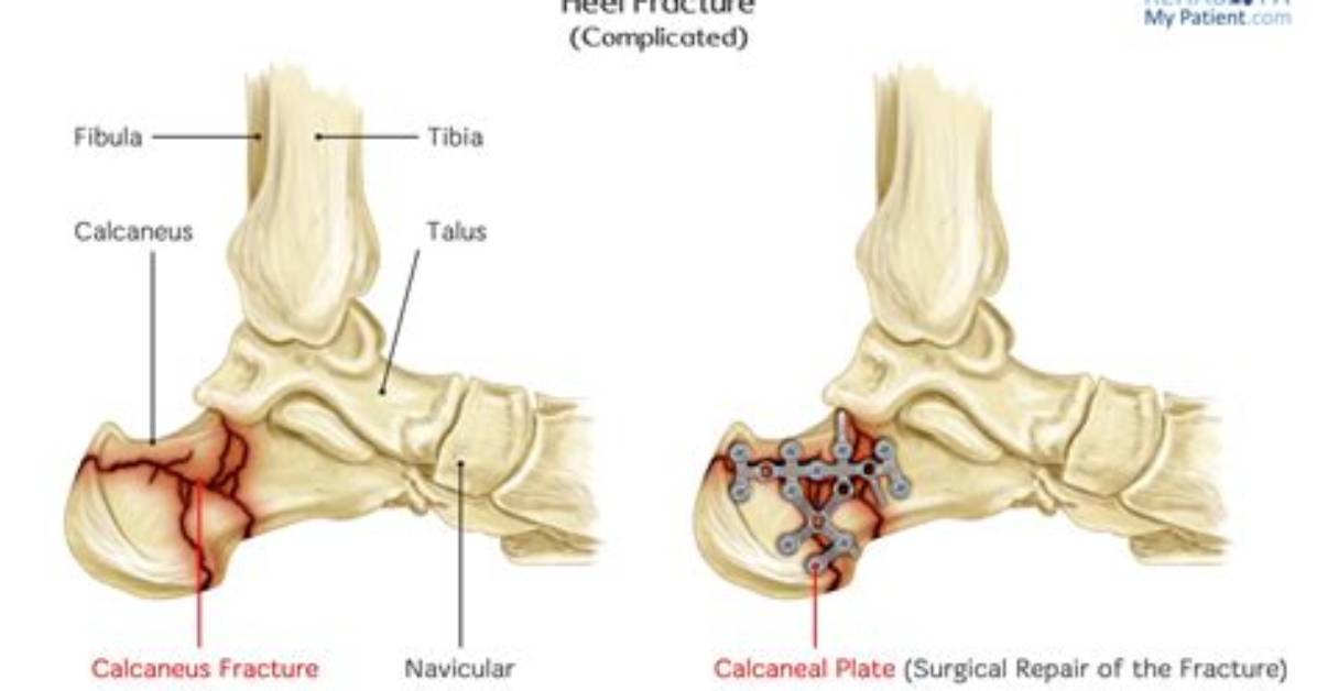 Does a Broken Heel Bone Require Surgery?