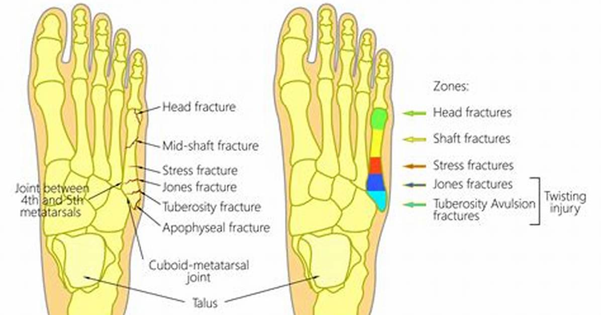 Does a Broken Metatarsal Need Surgery?