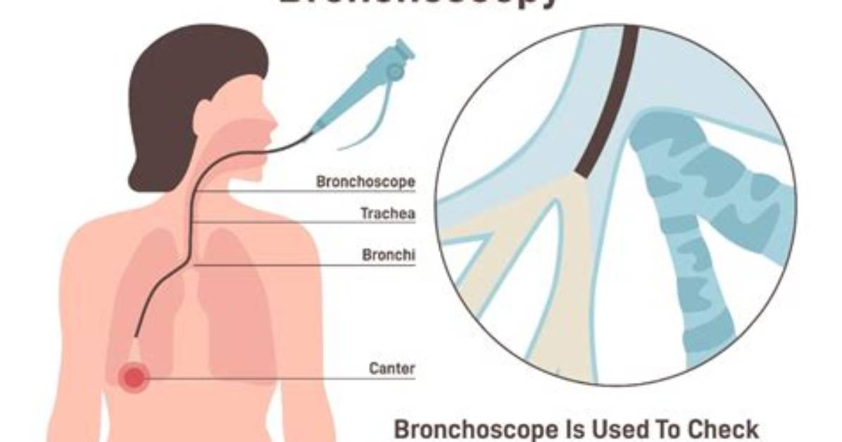 Does a Bronchoscopy Go into the Lungs?