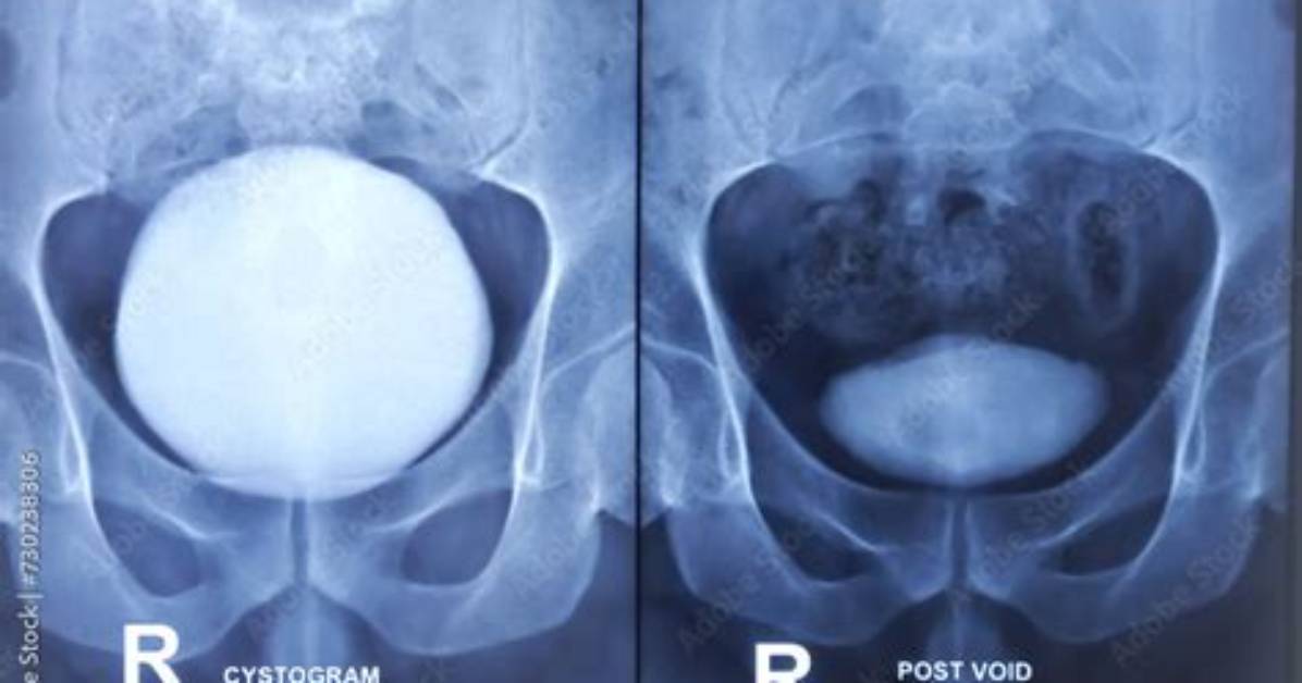 Does a Cystogram Hurt?