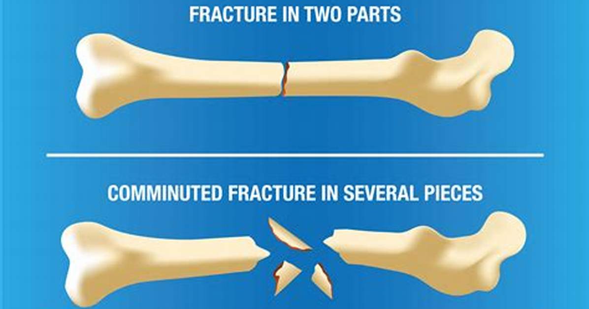 Does a Fracture Mean Broken?