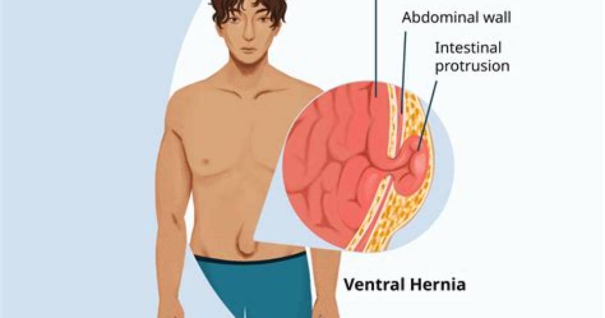 Does a Hernia Go Away?