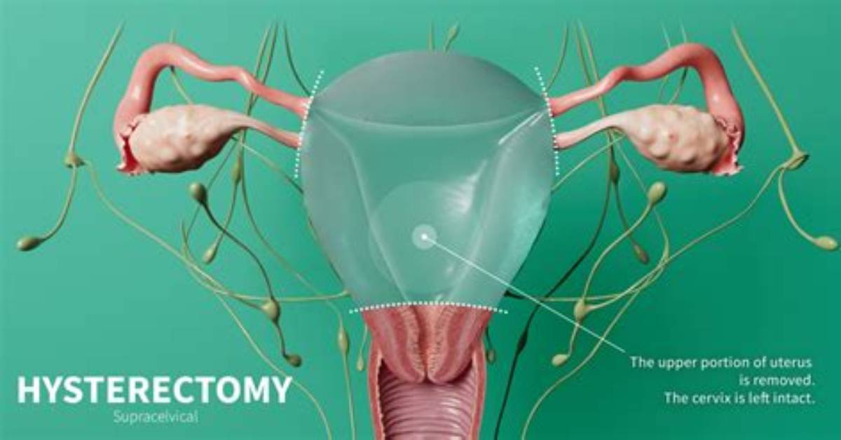 Does a Hysterectomy Remove the Cervix?