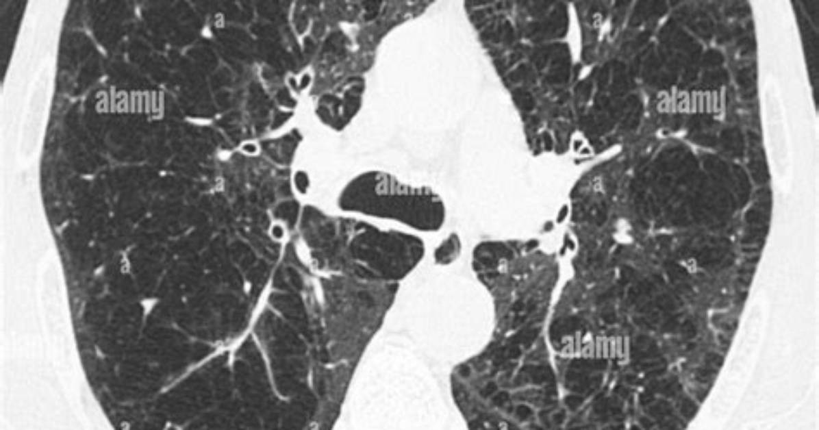 Does a Lung Ct Scan Show Copd?