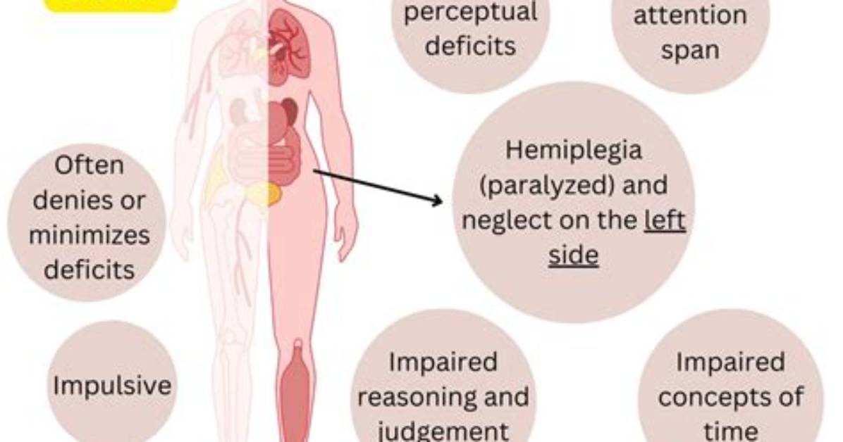 Does a Right Sided Stroke Affect Speech?