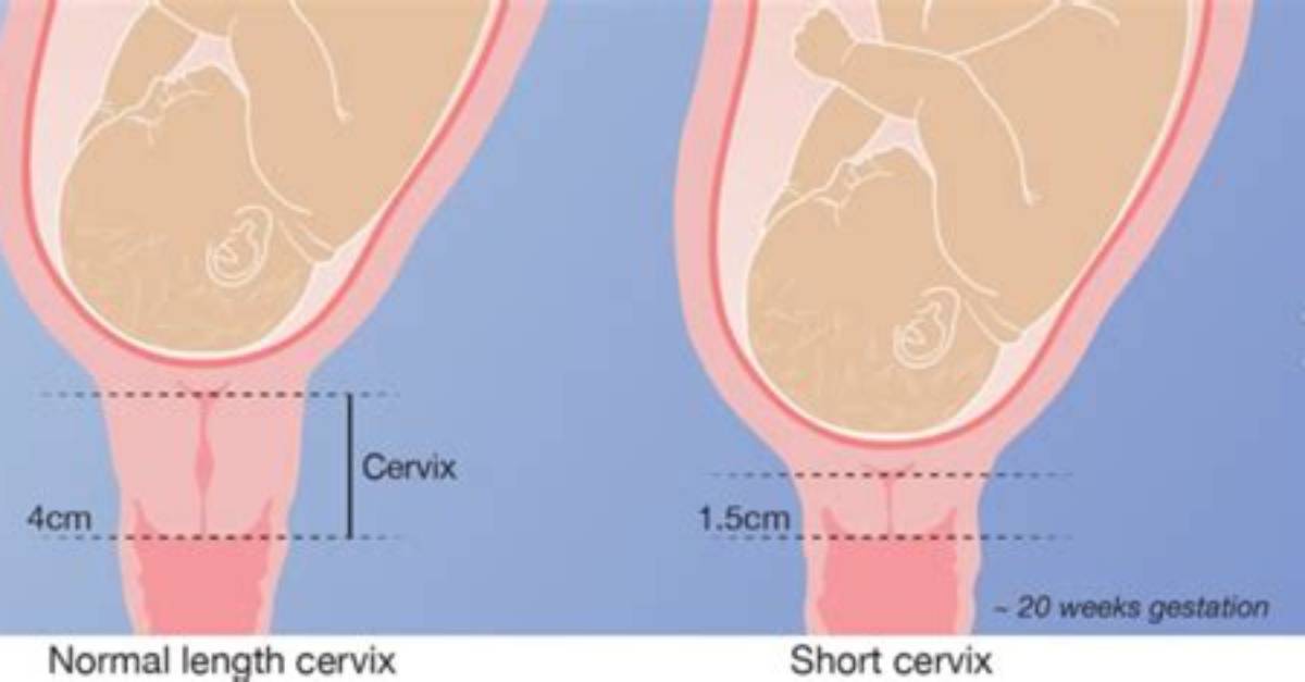 Does a Short Cervix Mean Shorter Labor?