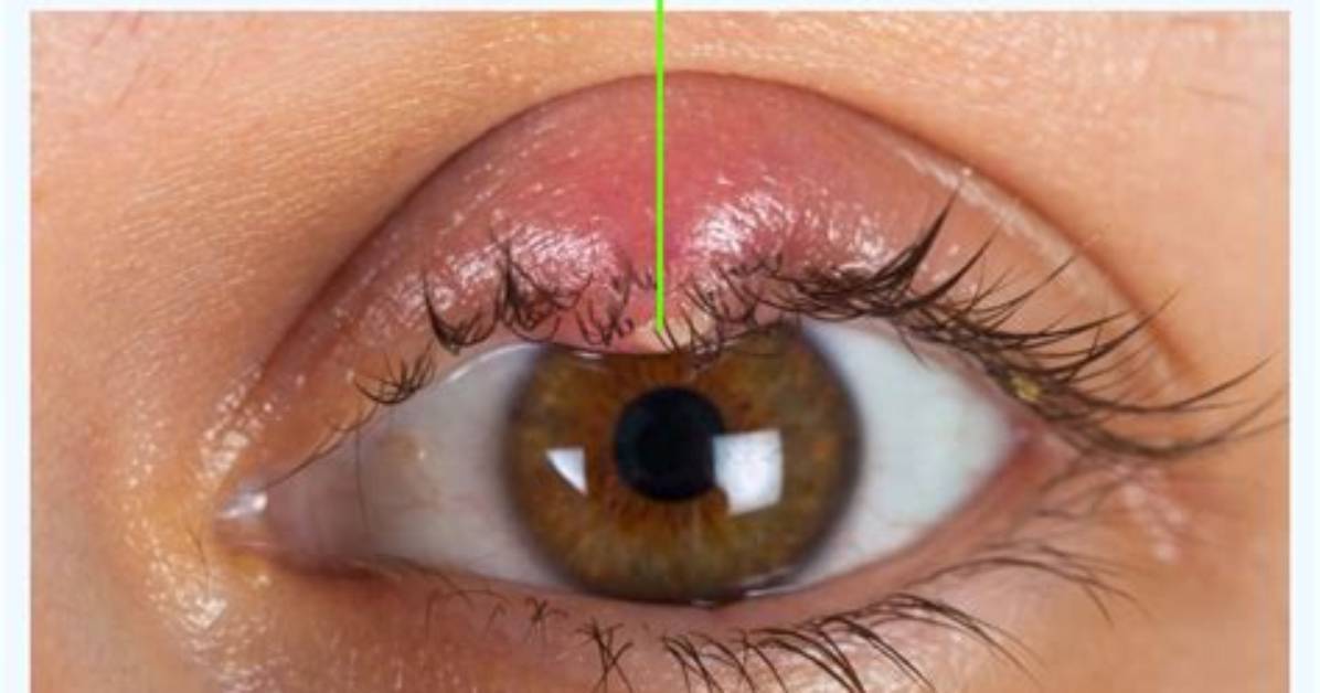 Does a Stye Hurt?