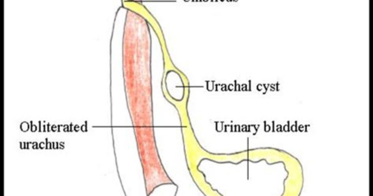 Does a Urachus Hurt?