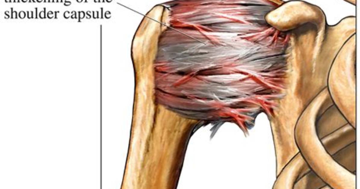 Does Adhesive Capsulitis Recur?
