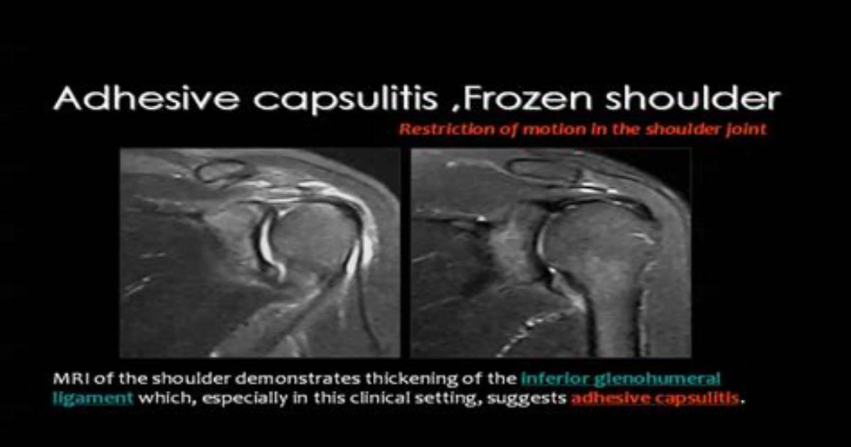 Does Adhesive Capsulitis Show up on Mri?
