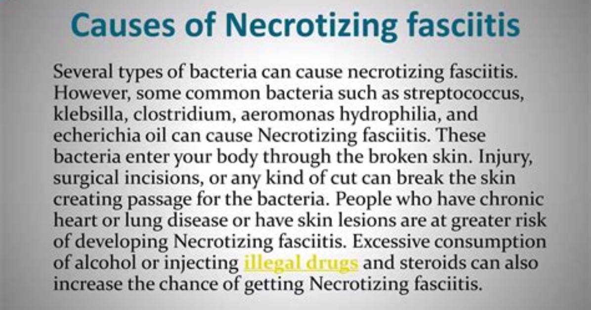 Does Alcohol Kill Necrotizing Fasciitis?