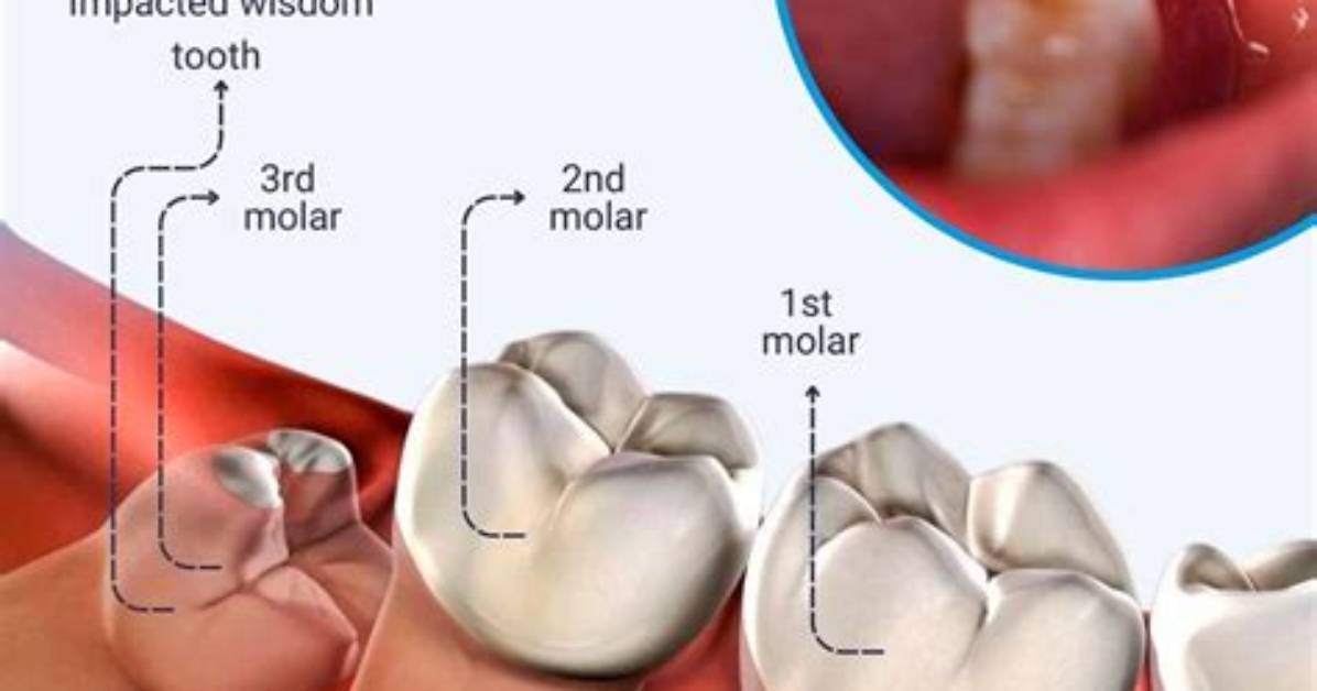 Does All Have Wisdom Teeth?