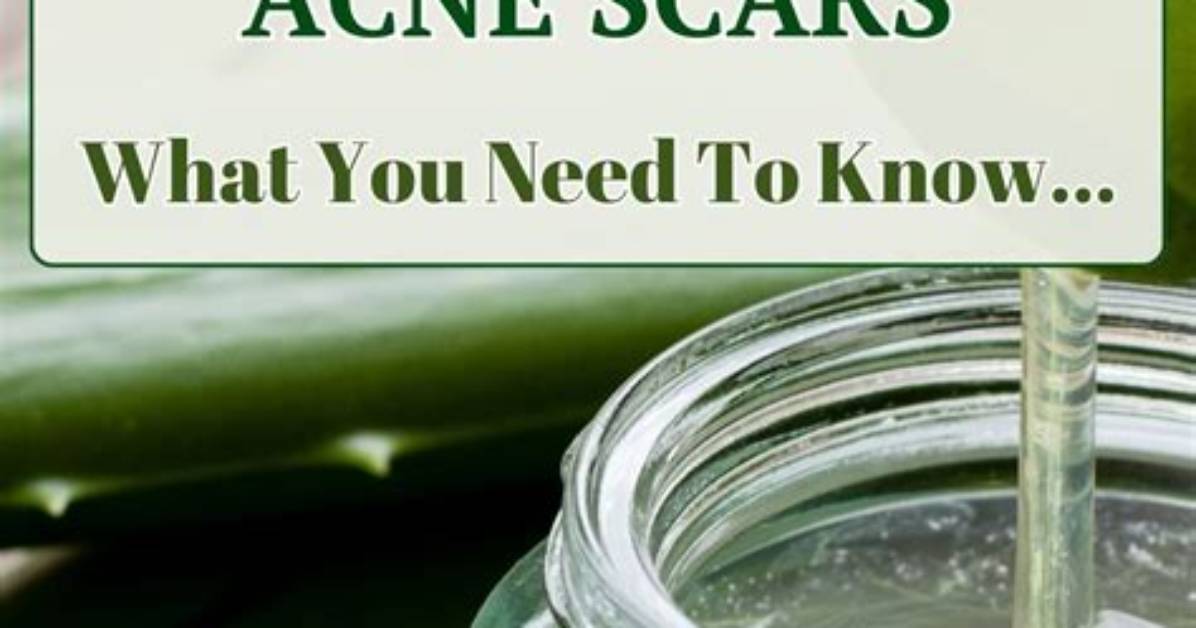 Does Aloe Vera Help Ice Pick Scars?