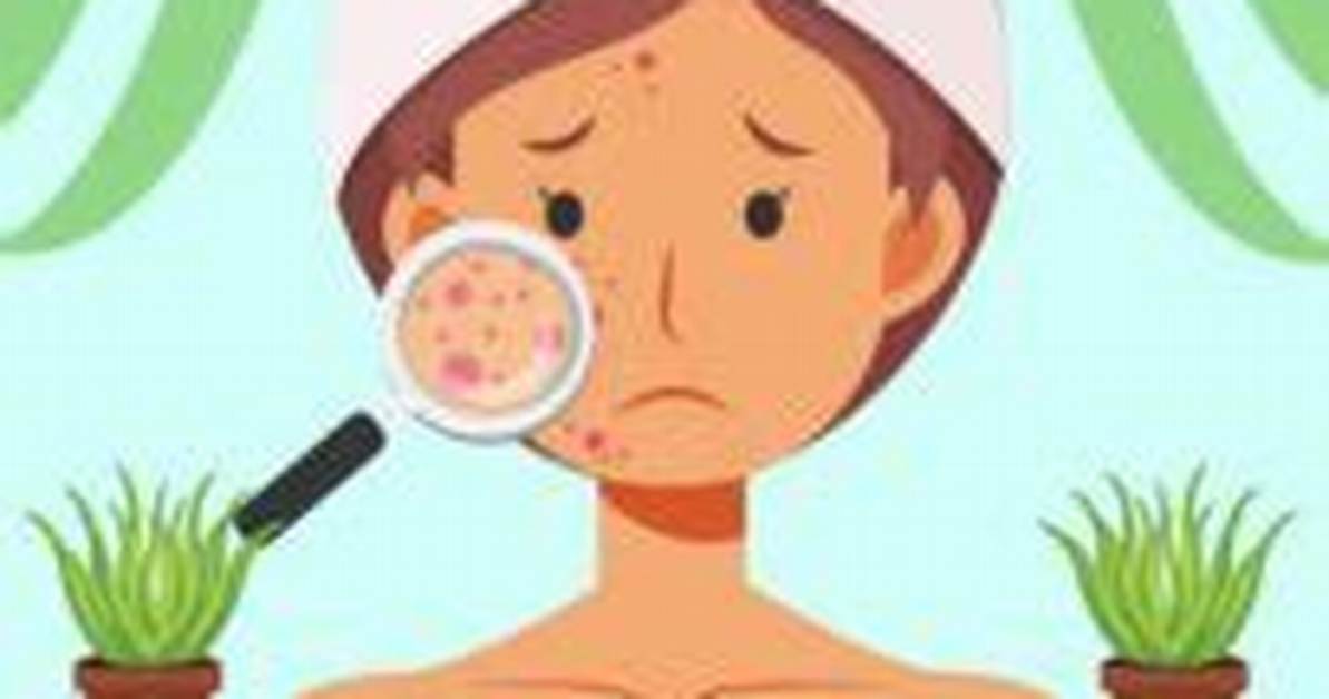 Does Aloe Vera Remove Pimples?
