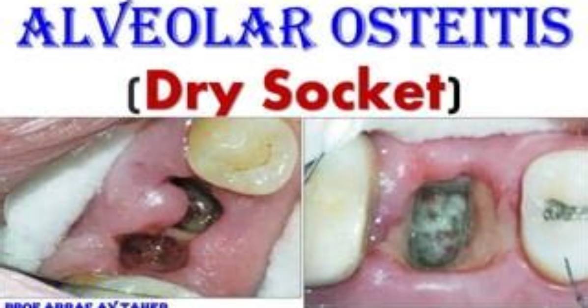 Does Alveolar Osteitis Causes Pain?