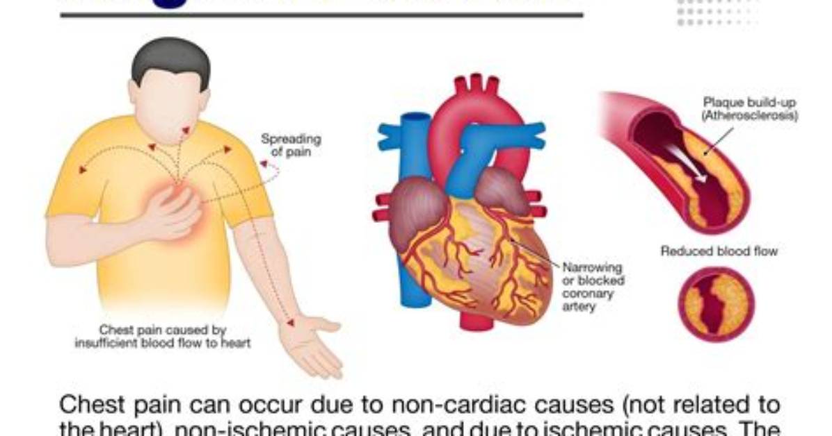 Does Angina Pectoris Causes Pain?