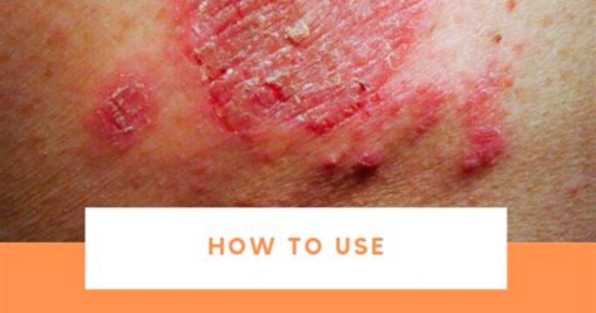 Does Apple Cider Vinegar Help Dyshidrotic Eczema?