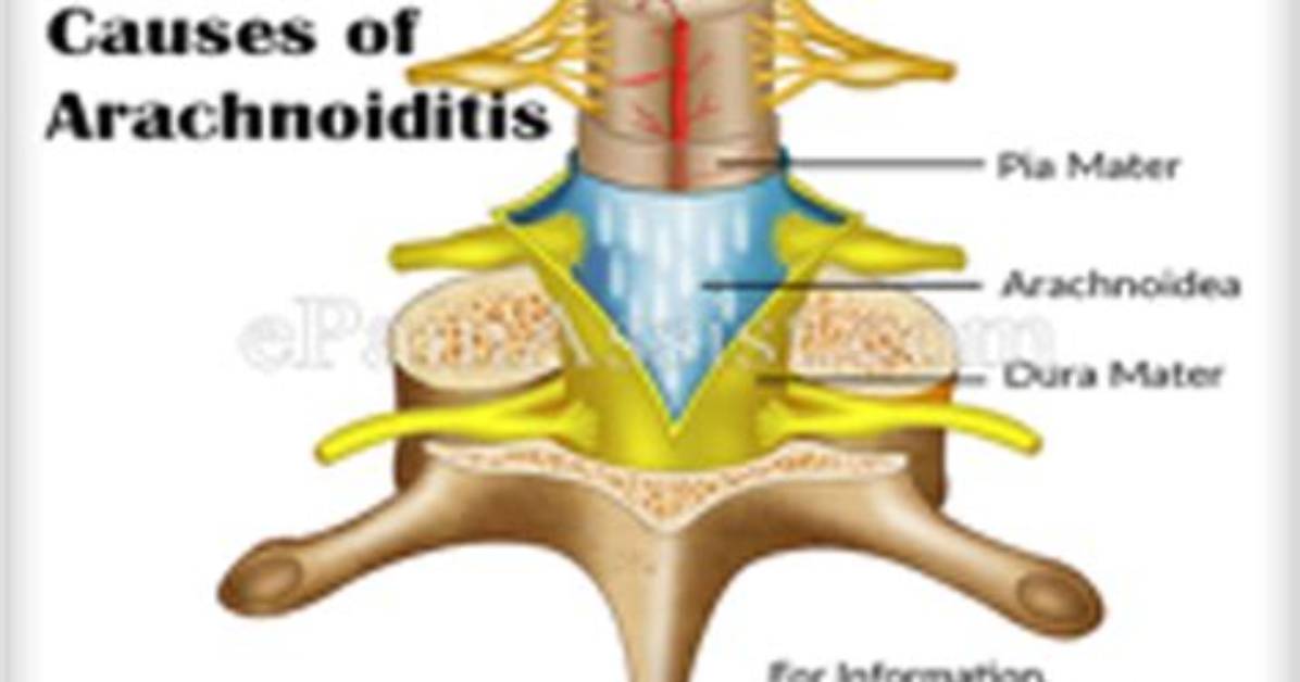 Does Arachnoiditis Come and Go?