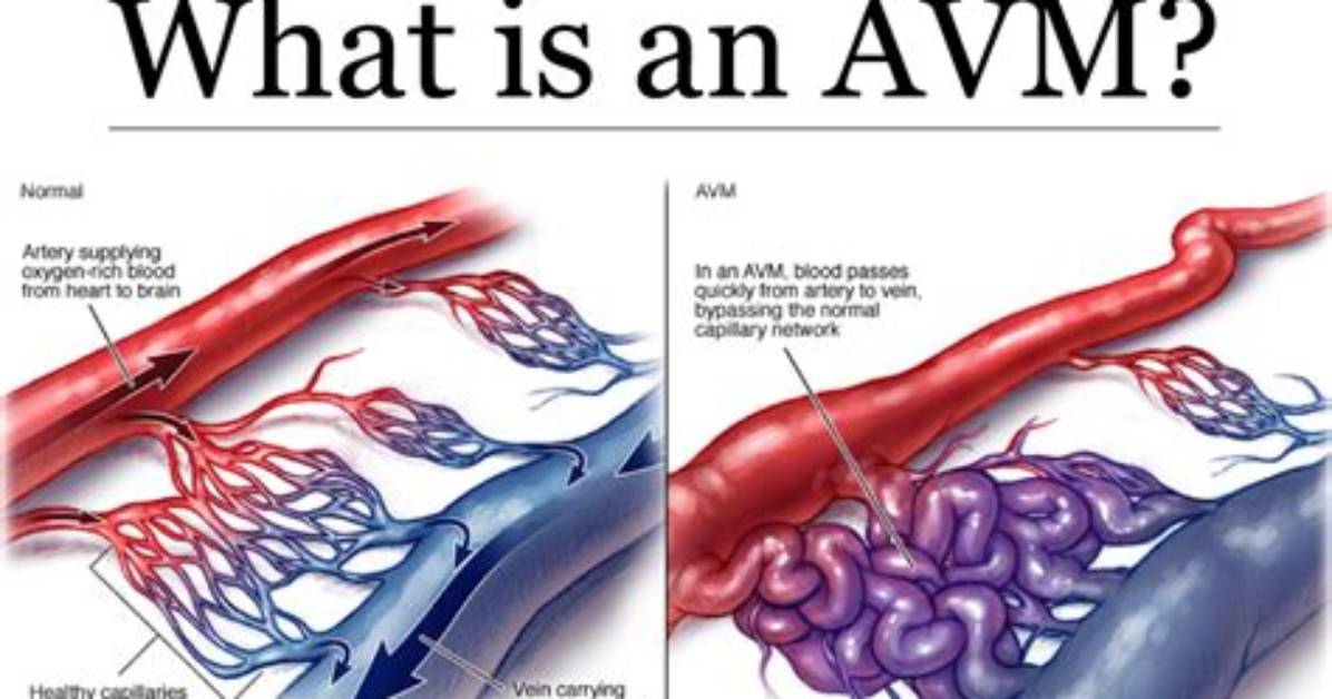 Does Arteriovenous Malformation Spread?
