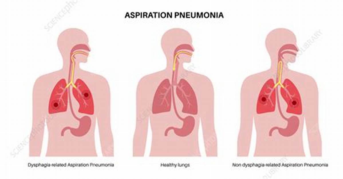 Does Asphyxia Cause Aspiration?
