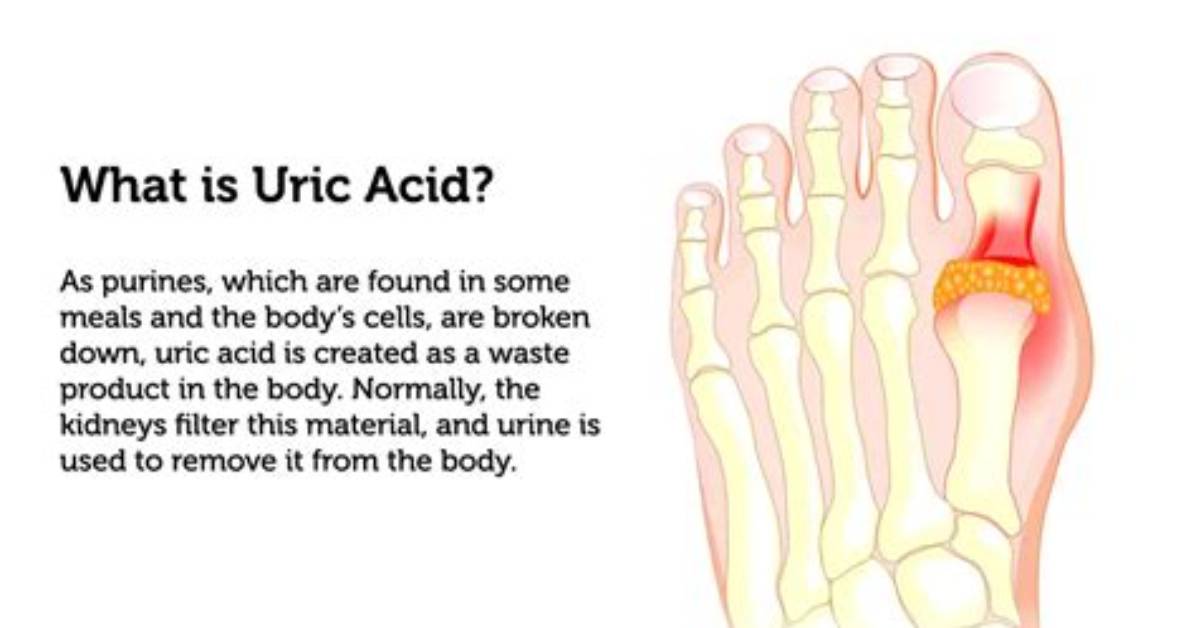 Does Aspirin Increase Uric Acid