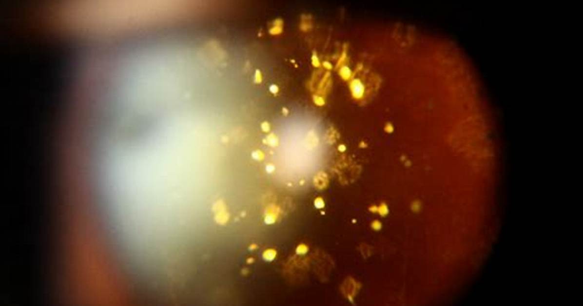 Does Asteroid Hyalosis Affect Vision?