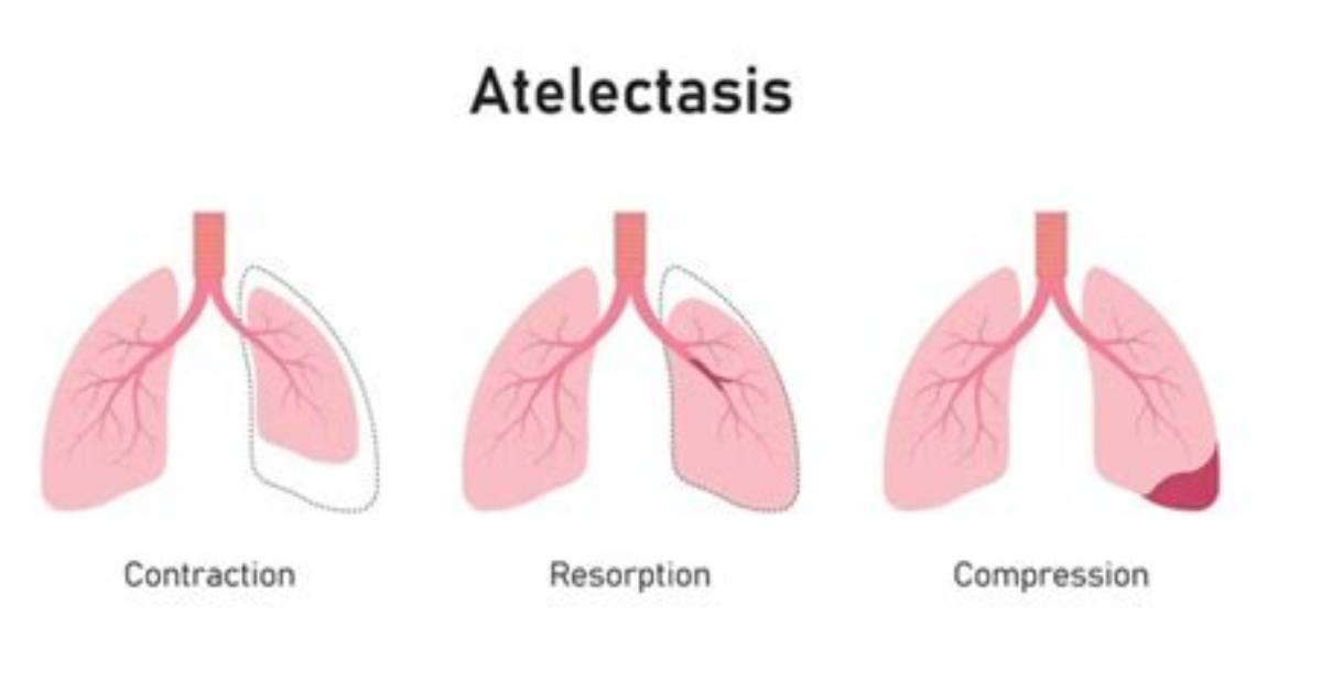 Does Atelectasis Resolve Itself?