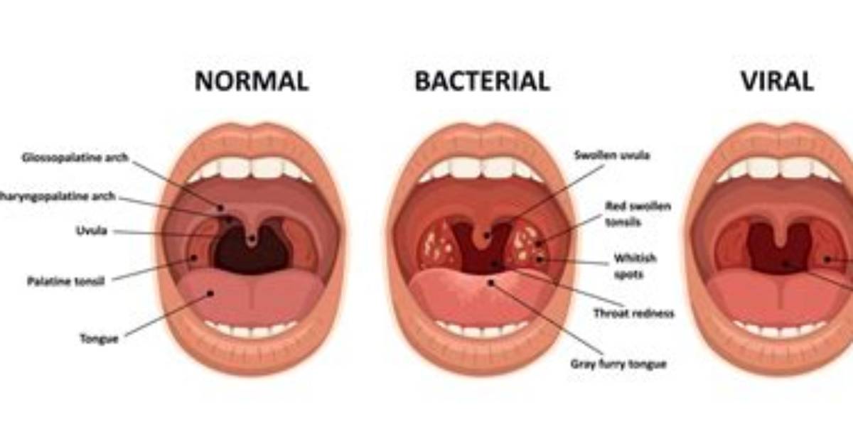 Does Bacterial Tonsillitis Go Away by Itself?