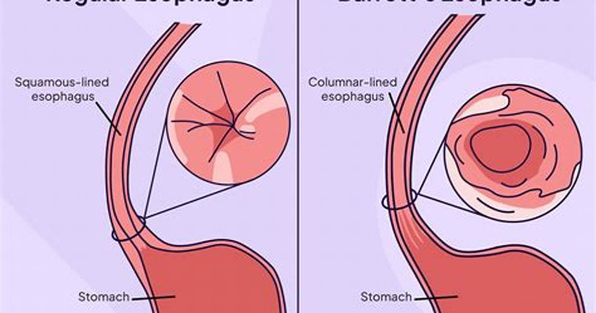 Does Barrett's Esophagus Cause Nausea?
