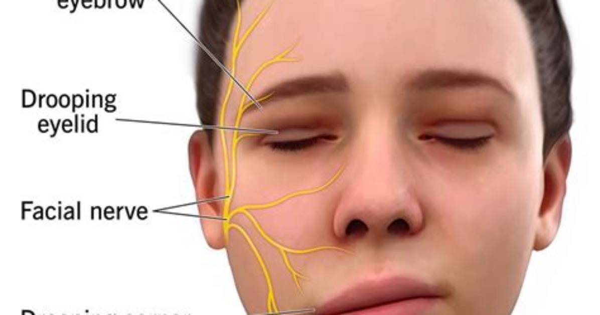Does Bells Palsy Affect Breathing?