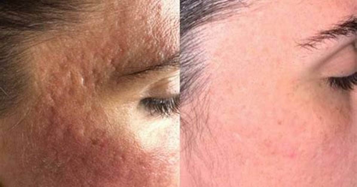 Does Beyaz Help with Acne