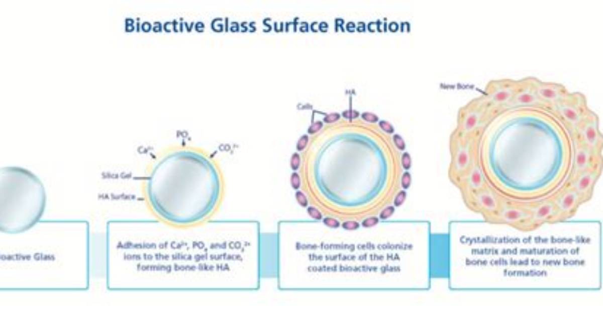 Does Bioglass Really Work?