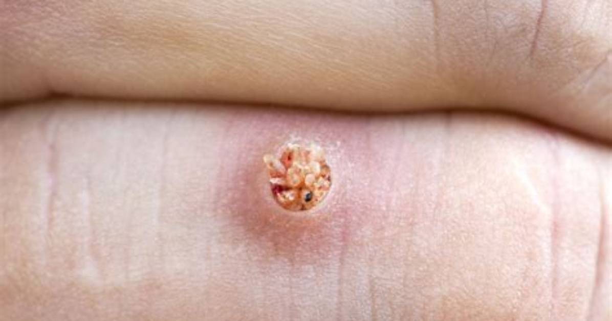 Does Bleach Kill Wart Virus?