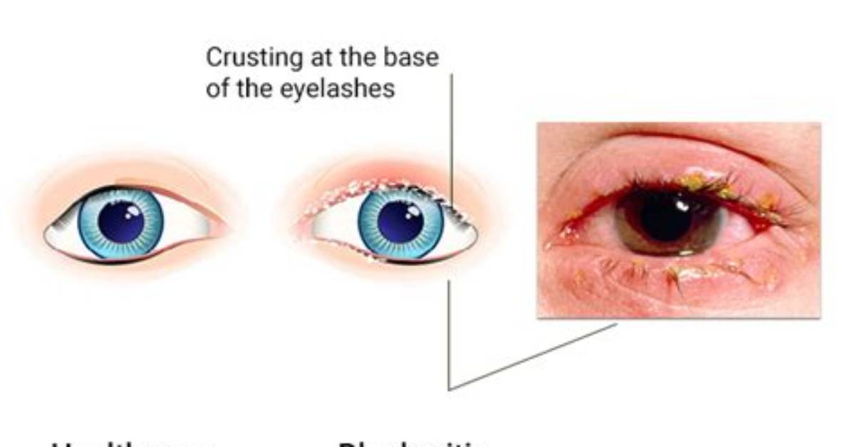 Does Blepharitis Ever Go Away?