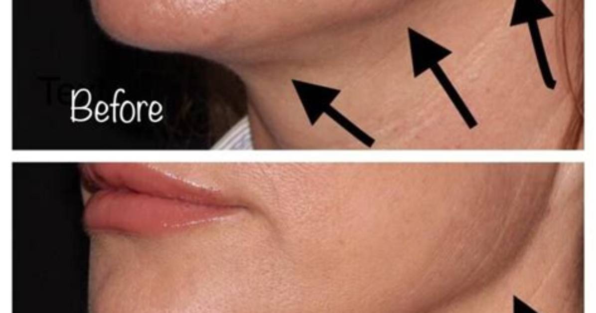 Does Botox Help Jowls?