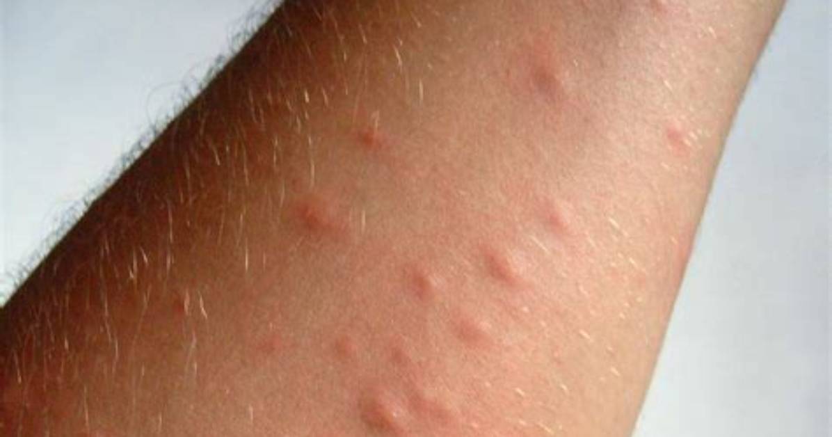 Does Browntail Moth Rash Spread?