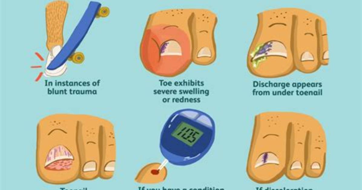 Does Bruised Toenail Always Fall off?