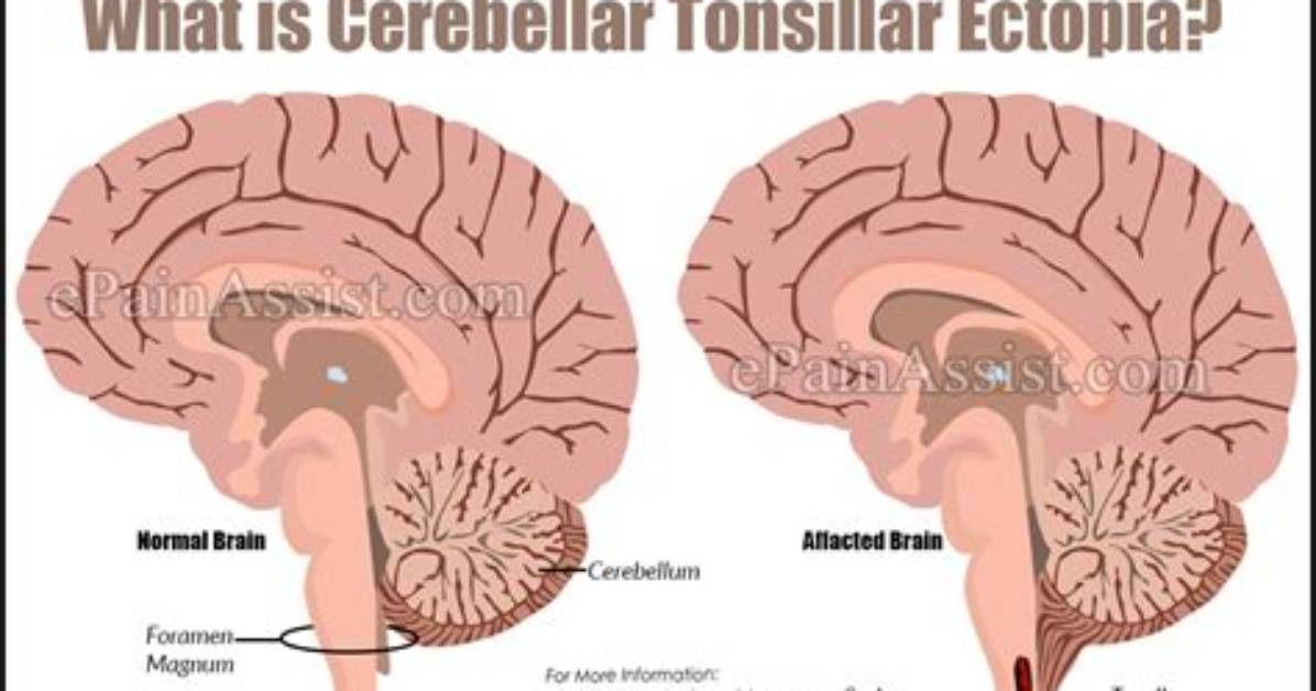 Does Cerebellar Tonsillar Ectopia Require Surgery?