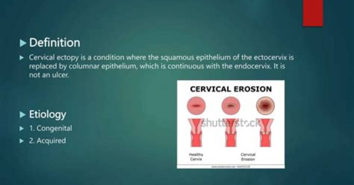 Does Cervical Ectopy Go Away?