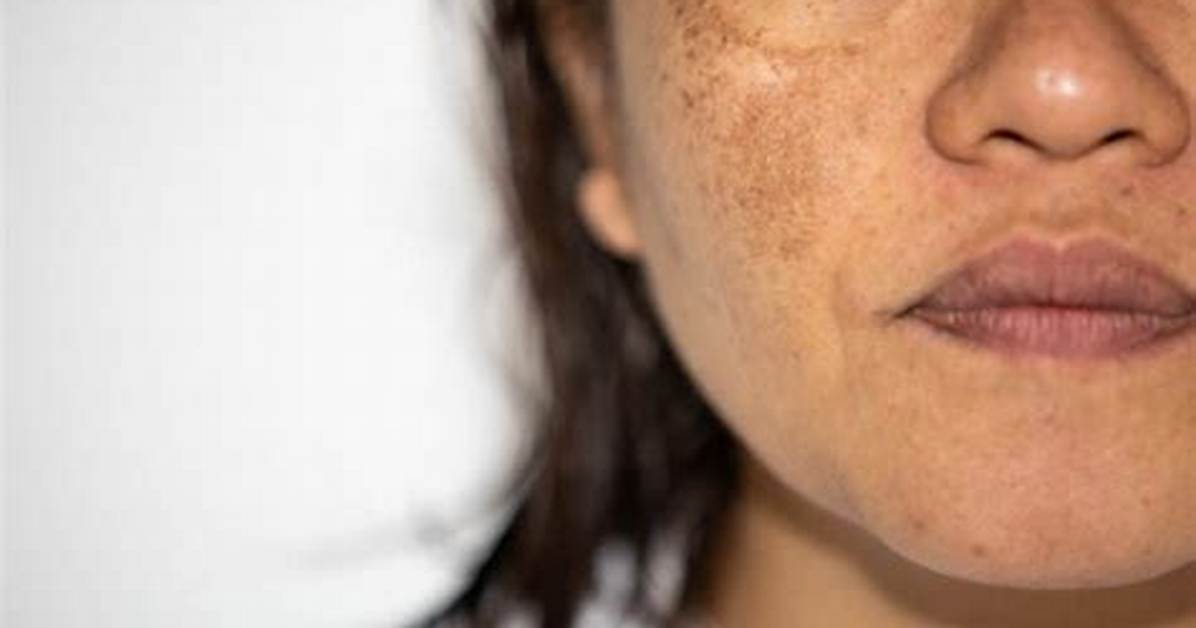 Does Chloasma Go Away?