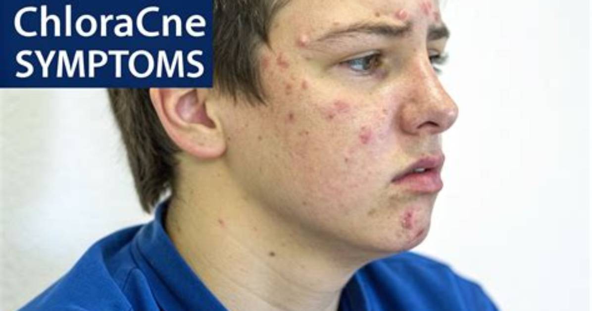 Does Chloracne Go Away?